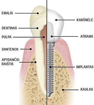 Dantu_harmonija_implantas_lt