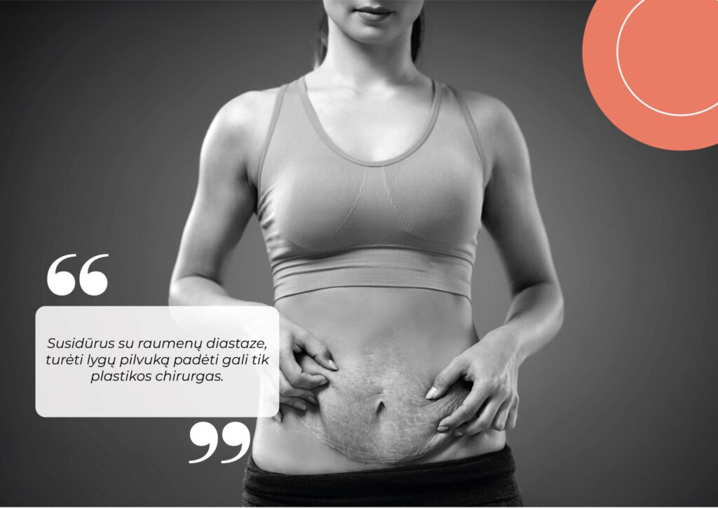 Kaip išspręsti prasiskyrusių pilvo raumenų problemą po gimdymo?